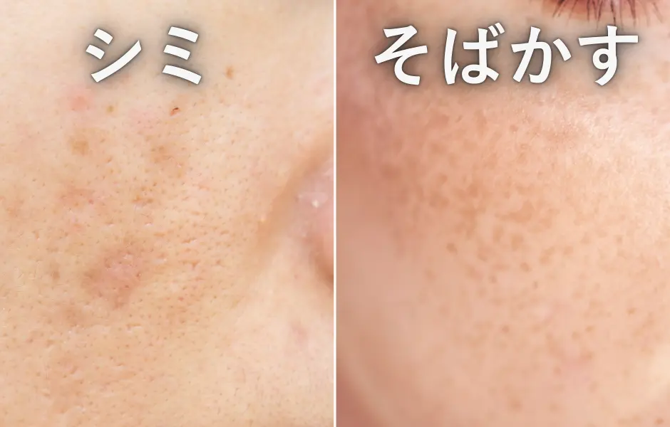 シミ そばかす